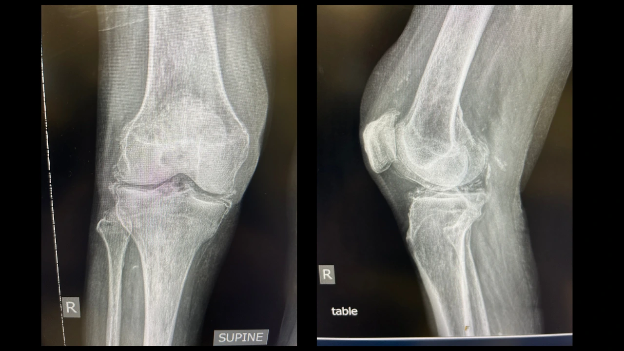 X-ray of right knee showing supine view with femur, tibia, and fibula bones